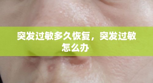 突發(fā)過(guò)敏多久恢復(fù)，突發(fā)過(guò)敏怎么辦 