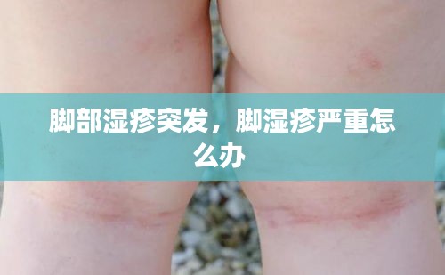 腳部濕疹突發(fā)，腳濕疹嚴重怎么辦 